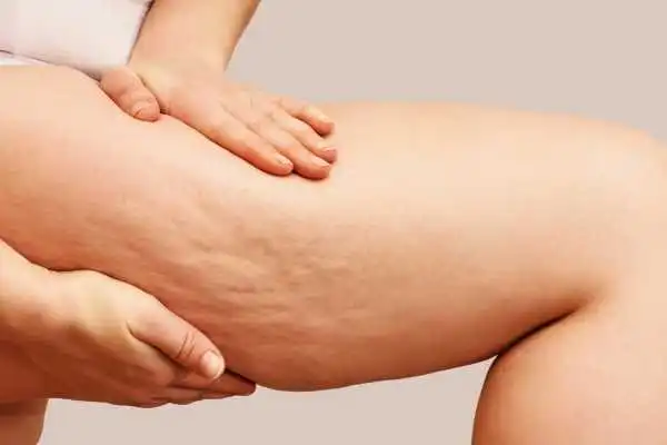 Image of woman showing leg with cellulite Gateshead
