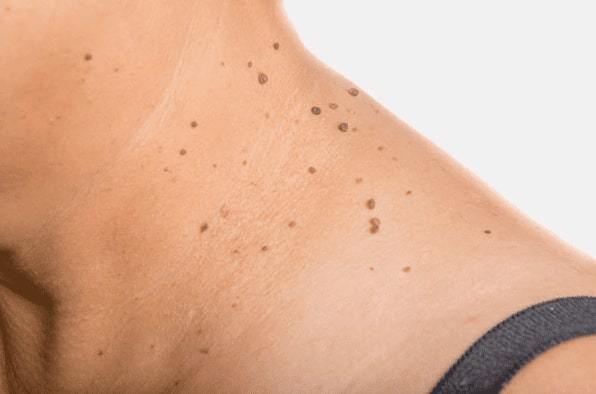 Are you looking for easy skin tag removal Gateshead - then contact Spire today!