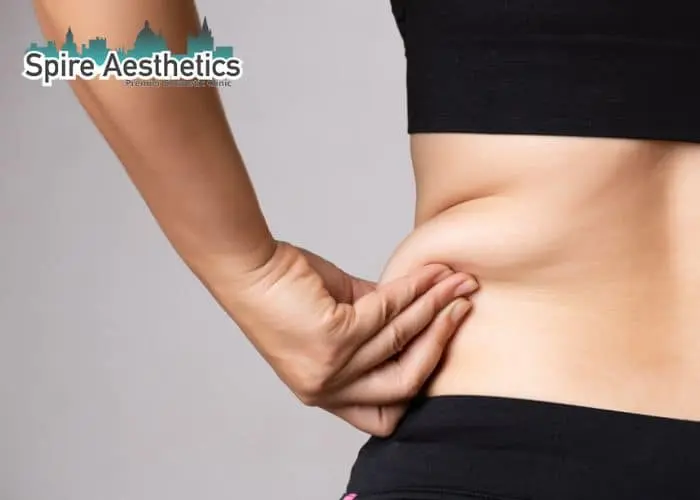 Image of woman pinching fat on their hips Gateshead. Fat Freezing treatment