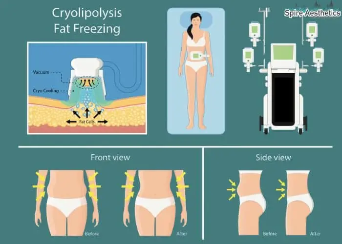 Fat freezing treatment Gateshead benefits for competitions to remove stubborn fat deposits.