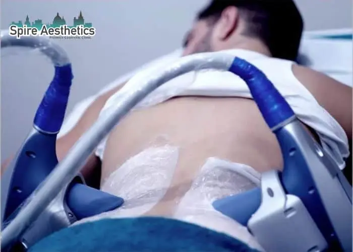 Man having fat freezing treatment done on love handles before a competitions Gateshead to create a sculpted look.