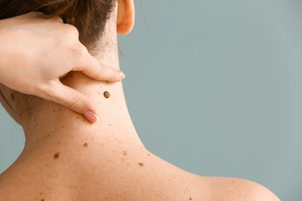 skin blemish removal Gateshead treatment
