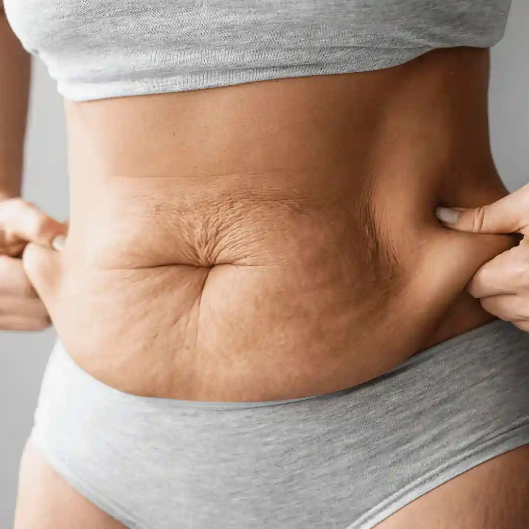 Is It Normal to Have Loose Skin After Pregnancy Gateshead?